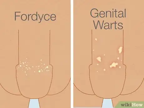 Imagen titulada Get Rid of Fordyce Spots Step 11