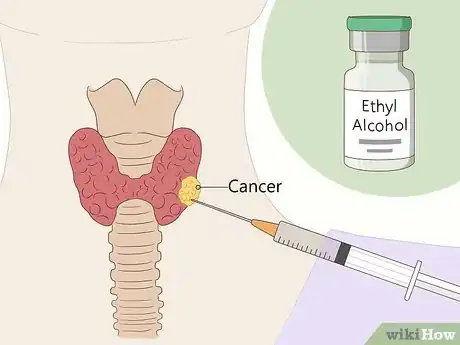 Imagen titulada Dissolve Nodules Naturally Step 9