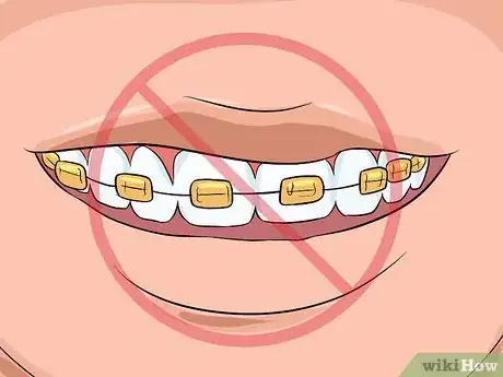 Imagen titulada Choose the Color of Your Braces Step 14