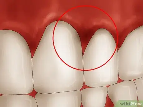 Imagen titulada Get Rid of Gingivitis Step 1