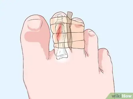 Imagen titulada Bandage Fingers or Toes Step 20