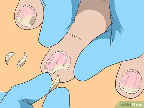 Imagen titulada Get Rid of Psoriasis on Your Nails Step 6