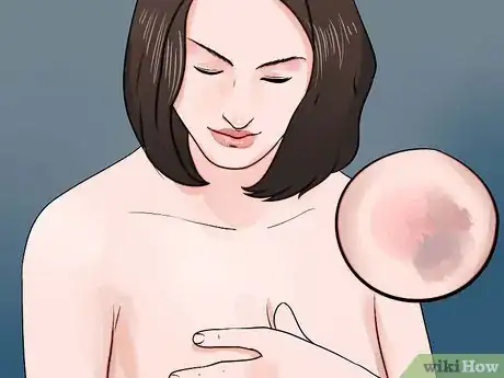 Imagen titulada Heal Breast Implants Step 12