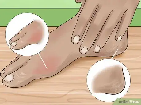 Imagen titulada Care for Rough, Dry Feet Step 12