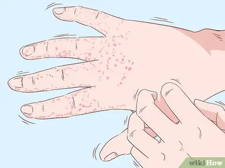 Imagen titulada Treat Hand Eczema Step 1