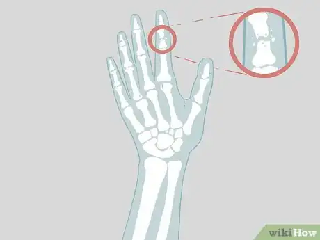 Imagen titulada Determine if a Finger Is Broken Step 16