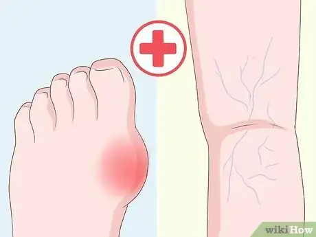 Imagen titulada Get Rid of Leg Pain Step 14