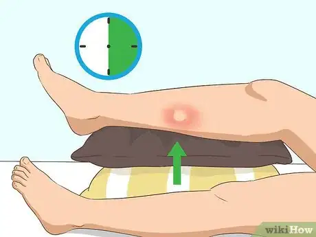 Imagen titulada Reduce Bug Bite Swelling Step 5