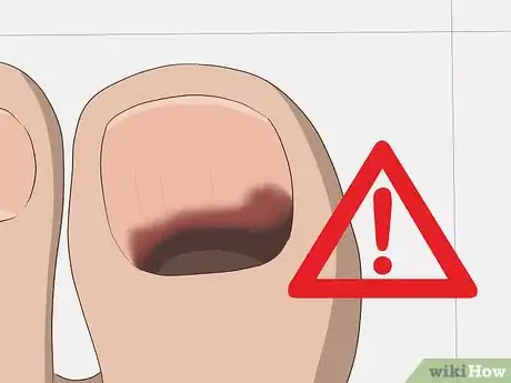 Imagen titulada Treat a Black Toenail Step 1