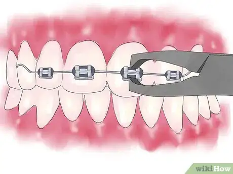 Imagen titulada Fix Crooked Teeth Step 25