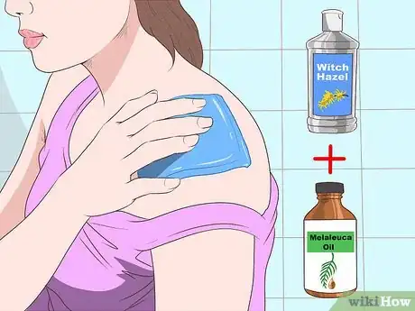 Imagen titulada Stop Mosquito Bites from Itching Step 16