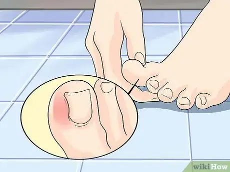 Imagen titulada Heal an Ingrown Toenail Step 10