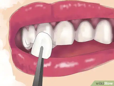 Imagen titulada Fix Crooked Teeth Step 17