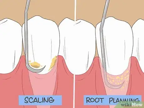 Imagen titulada Treat a Gum Infection Step 9