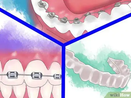 Imagen titulada Fix Crooked Teeth Step 20