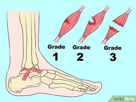 Imagen titulada Treat a Sprained Ankle Step 1