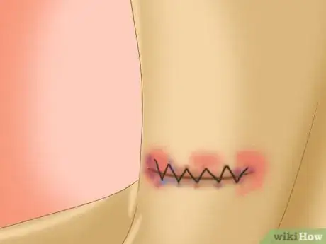 Imagen titulada Take Care of an Incision After Thyroid Surgery Step 4