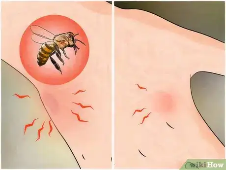 Imagen titulada Identify a Spider Bite Step 5