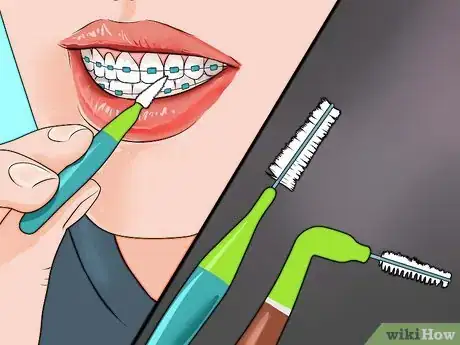 Imagen titulada Smile With Braces Step 12