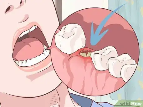 Imagen titulada Prepare for Tooth Extraction Step 13