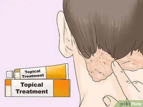 Imagen titulada Get Rid of an Itchy Scalp Step 9