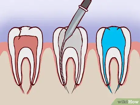 Imagen titulada Treat a Broken Tooth Step 14