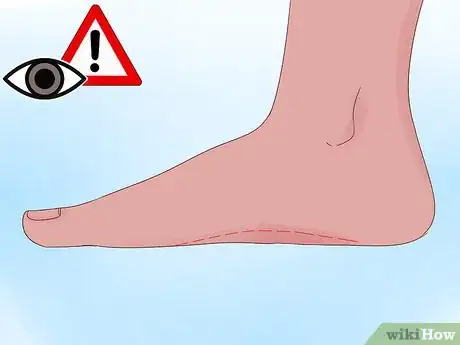 Imagen titulada Fix Pronated Feet Step 11