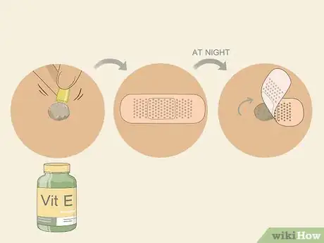 Imagen titulada Get Rid of Warts Step 13