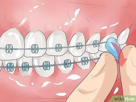 Imagen titulada Handle Poking Wires on Braces Step 5