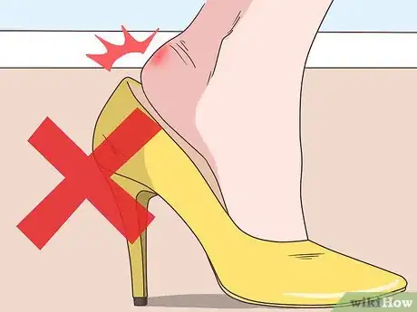 Imagen titulada Treat a Foot Blister Step 15