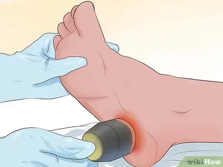 Imagen titulada Get Rid of a Wart at the Bottom of Your Foot Step 11