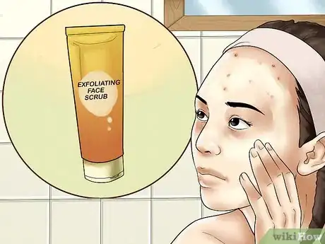 Imagen titulada Get Rid of Forehead Acne Step 12