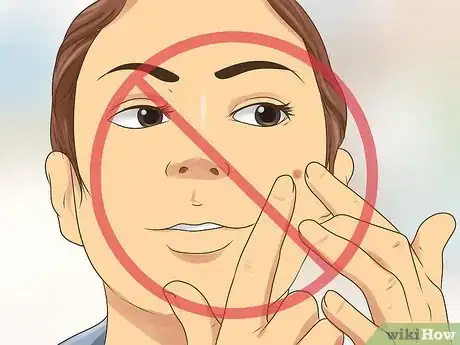 Imagen titulada Erase a Pimple Scar Step 12