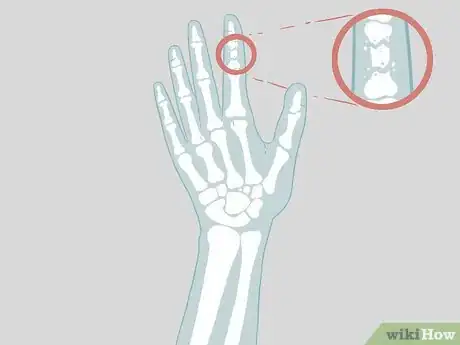 Imagen titulada Determine if a Finger Is Broken Step 18