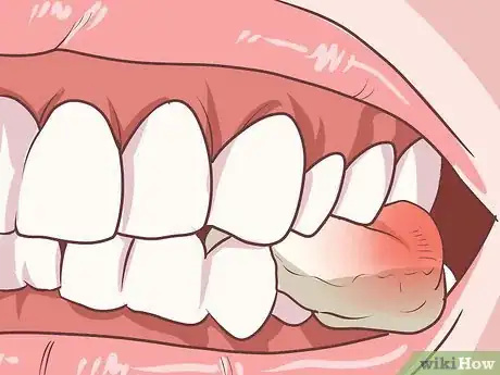 Imagen titulada Prepare for Tooth Extraction Step 16