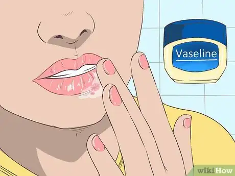 Imagen titulada Treat a Cold Sore or Fever Blisters Step 17
