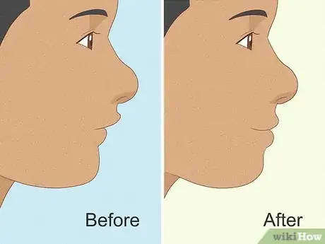 Imagen titulada Cope with Twin Block Braces Step 7