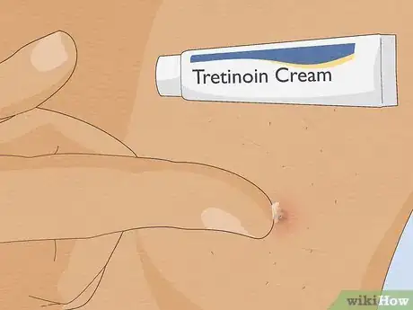 Imagen titulada Remove an Ingrown Hair Under the Skin Step 10