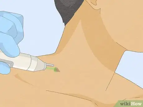 Imagen titulada Remove a Skin Tag from Your Neck Step 6