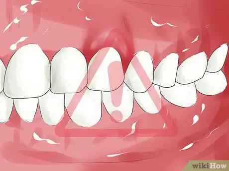 Imagen titulada Know if You Have an Infected Tooth Step 4