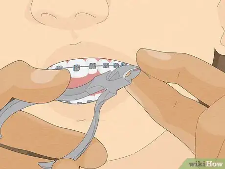 Imagen titulada Temporarily Fix a Loose Wire on Your Braces Step 11