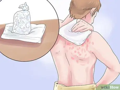 Imagen titulada Get Rid of a Skin Rash Caused by Antibiotic Allergy Step 8