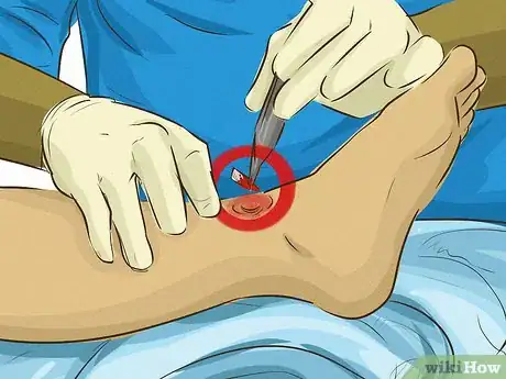 Imagen titulada Stop Bleeding Step 17