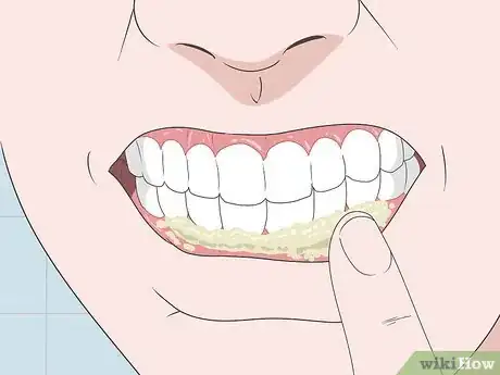 Imagen titulada Treat a Gum Infection Step 5