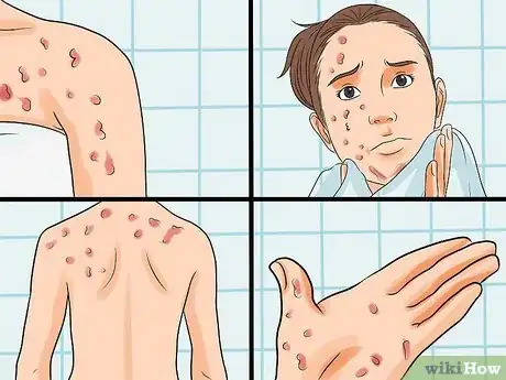 Imagen titulada Identify an HIV Rash Step 2