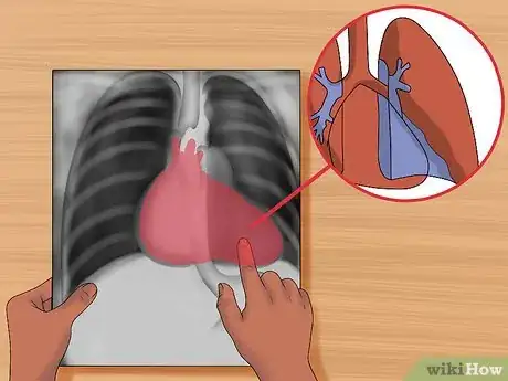 Imagen titulada Read a Chest X Ray Step 16