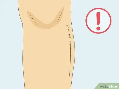 Imagen titulada Recognize Gout Symptoms Step 17