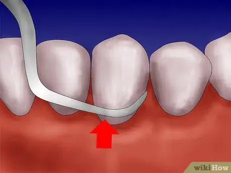 Imagen titulada Get Rid of Gingivitis Step 3