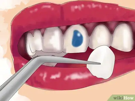 Imagen titulada Fix Crooked Teeth Step 14