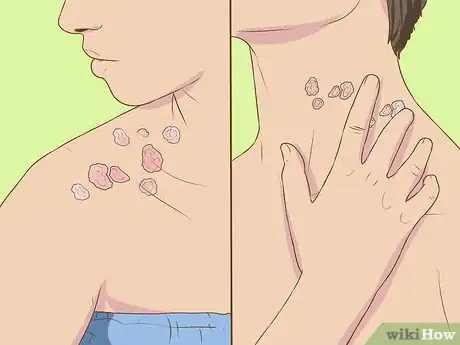 Imagen titulada Recognize Shingles Symptoms (Herpes Zoster Symptoms) Step 2